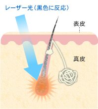 脱毛の原理